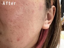 オアシスラグーン(OASIS LAGOON)/ニキビケア（症例３：after）