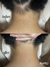 アシュリー 表参道(AsHLi)/メンズ脱毛