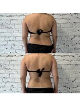 ザ レディービー(The Lady B)/背中肉撃退