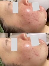 ラエッセ 恵比寿(LAESSE)/毛穴・美白専門店 LAESSE 恵比寿