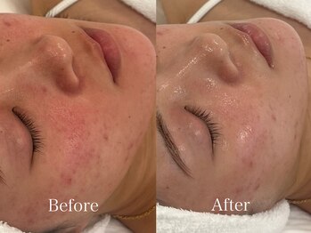 リフコウベ(LIF KOBE)/赤み：アンストレス1回