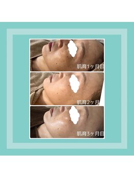 エフエフディースキンケア(FFD SKINCARE)/エイジング/シミ/リフトアップ