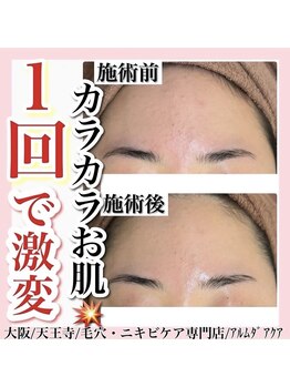 アルムダアクア 天王寺店(Aleumda AQUA)/ハーブピーリング/大阪/天王寺