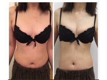 美人バスト 本厚木店/バストアップ◇症例◇