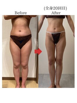 バーチュ(Virtue)/頑固な脂肪へアタック！