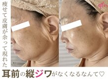 ソワンドビジュー(soin de bijew)/極上のインディバフェイシャル