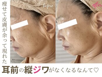 ソワンドビジュー(soin de bijew)/極上のインディバフェイシャル