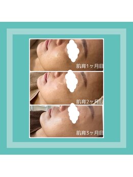 エフエフディースキンケア(FFD SKINCARE)/毛穴/くすみ/敏感