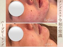 ラナ(LaNa)/メンズハーブピーリング★