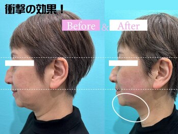 オンダリフト東京　大阪梅田店【韓国肌管理】オンダリフト/ララ ピール/小顔矯正/痩身/オンダリフト/梅田/ララピール