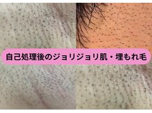 ディスイズミー シュガーリング(This is me Sugaring)の雰囲気(ジョリジョリ肌を卒業するには剃刀・ピンセットを辞めるのが近道)