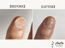 トトヘアー アンド ネイル(toto hair and nail)/変形したお爪の改善例