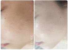 リセラージュ(Recellage)/グロッティ×泡エクソソーム導入