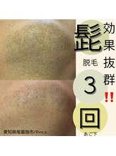 リンカ(Rinca)/尾張旭脱毛/髭脱毛