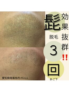 リンカ(Rinca)/尾張旭脱毛/髭脱毛