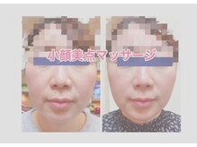 食い縛りによるエラ張り、頬のお肉、口元のお肉が気になる方に。