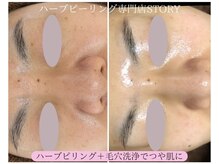 ストーリー(STORY)/ハーブピーリング専門店STORY