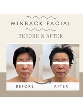 さかうえ接骨院/【BF/AF】WINBACKフェイシャル