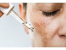 ナチュレアンドメディカ(Nature&Medica)/施術の流れ＜再生脱毛＞6