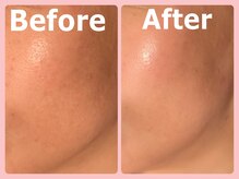 スイ 昭島店(Sui)/ハーブピーリング/シミケア/美白