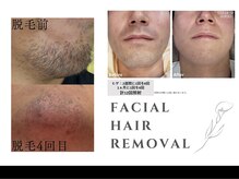 リリーミー(Rily Me)/ヒゲ脱毛