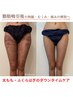 6月☆55％OFF【太もも/ふくらはぎ術後ケア】2部位インディバ60分15,000→