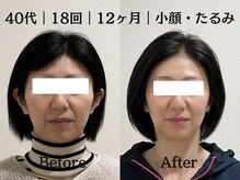 マルウル(maluulu)の雰囲気(フェイスラインが引き締まりリフトアップ、トーンアップ美小顔に)