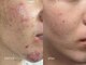 ソイ(SOI)の写真/【阪急烏丸駅すぐ】肌質改善トリートメント・毛穴洗浄・ララピール