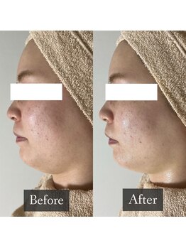 ベルフィーヌ 恵比寿店(BELFINE)/浮腫みやすいお顔もスッキリ☆