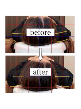 ナチュール(Nature)/巻き肩ビフォーアフター