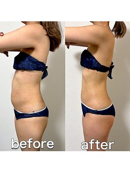 エステサロンクオーツ/全身痩せの結果♪