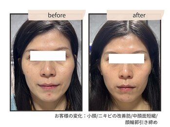 コンビンス(convince)/リフトアップ/輪郭の引き締め