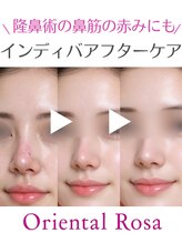 オリエンタルローザ 表参道(Oriental Rosa)/隆鼻術の術後悩みま最速改善♪