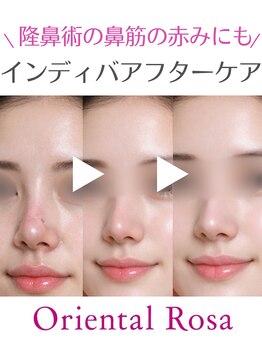オリエンタルローザ 表参道(Oriental Rosa)/隆鼻術の術後悩みま最速改善♪