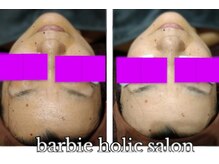 バービーホリック(barbie holic)/フェイシャルコース　施術前後