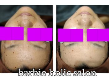 バービーホリック(barbie holic)/フェイシャルコース　施術前後