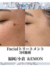アンドエモン(&EMON)/【お顔】プロセル効果