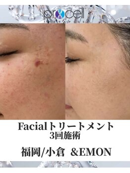 アンドエモン(&EMON)/【お顔】プロセル効果