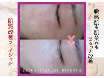 リヴェーヌ 富山店の写真/《毛穴が目立つ乾燥肌を潤い美肌へ》あなたに合う施術を豊富な知識＆メニューからご提供★
