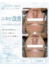 ホワイトアクア 北堀江店(WHITE AQUA)/ニキビ改善　艶肌