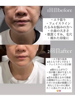 ベレカ(belleca)/骨格補正スパでたるみケア小顔☆