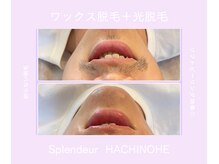 スプランドゥール 八戸(Splendeur)/ひげ脱毛