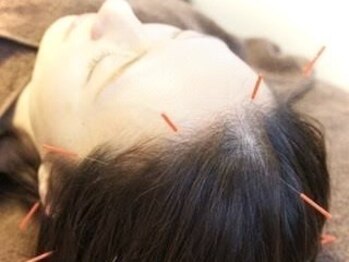 鍼灸院シマダ 宇多津(鍼灸院SHIMADA)の写真/【★首や肩のこりはもちろん、長年続く「頭痛」の鍼灸に専門特化】