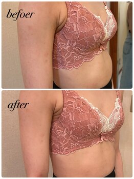 シャルマン(Charmant)/最新機器にて肋骨入れ込み