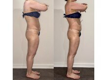 カルナ(CARNA)/【痩身】セルライトゼロ2