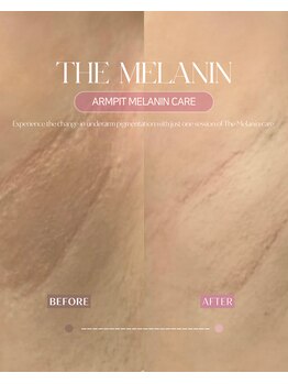 クレラ バイ コリアンビューティー 新大久保店(CLERA by Korean Beauty)/脇│THE MELANIN│ザメラニン