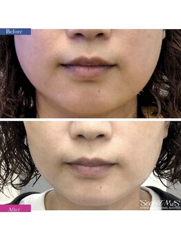 ユフラ(Juhla)/切らない小顔リフト