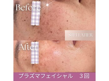 ステラティエ(Stellatier)/シミ/シワ/たるみ/リフトアップ