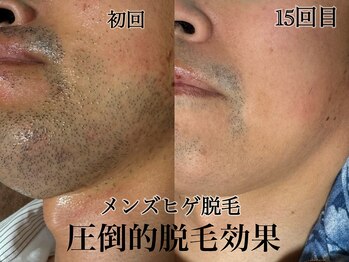 アンドエス 六本木(and S.)/頑固なヒゲもIPL×SHR脱毛で！