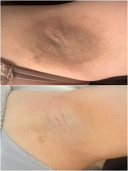 ビューティリュクス(beauty luxe)/ワキのくすみケア夏に間に合う!